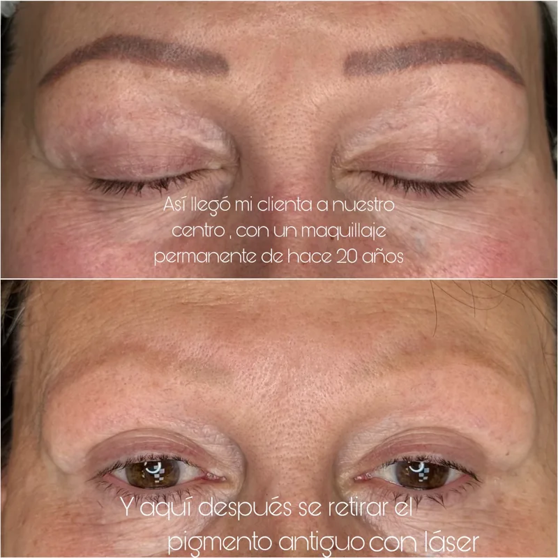 Cejas con una micropigmentación de hace 20 años y, debajo, después de retirar el pigmento con láser