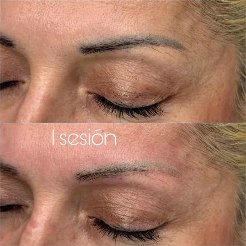 Cejas antes y después de una sesión de láser fotoacústico