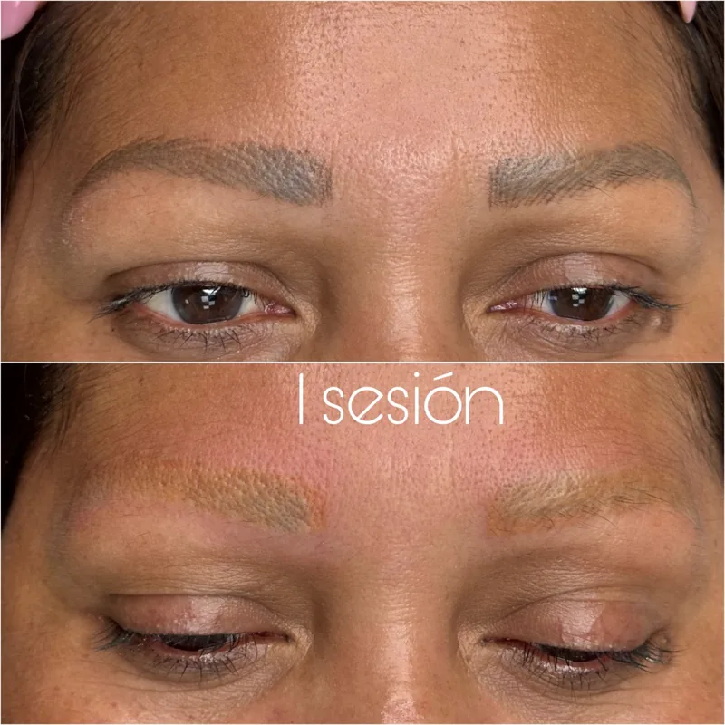 Micropigmentación de cejas antes y después de una sesión de láser