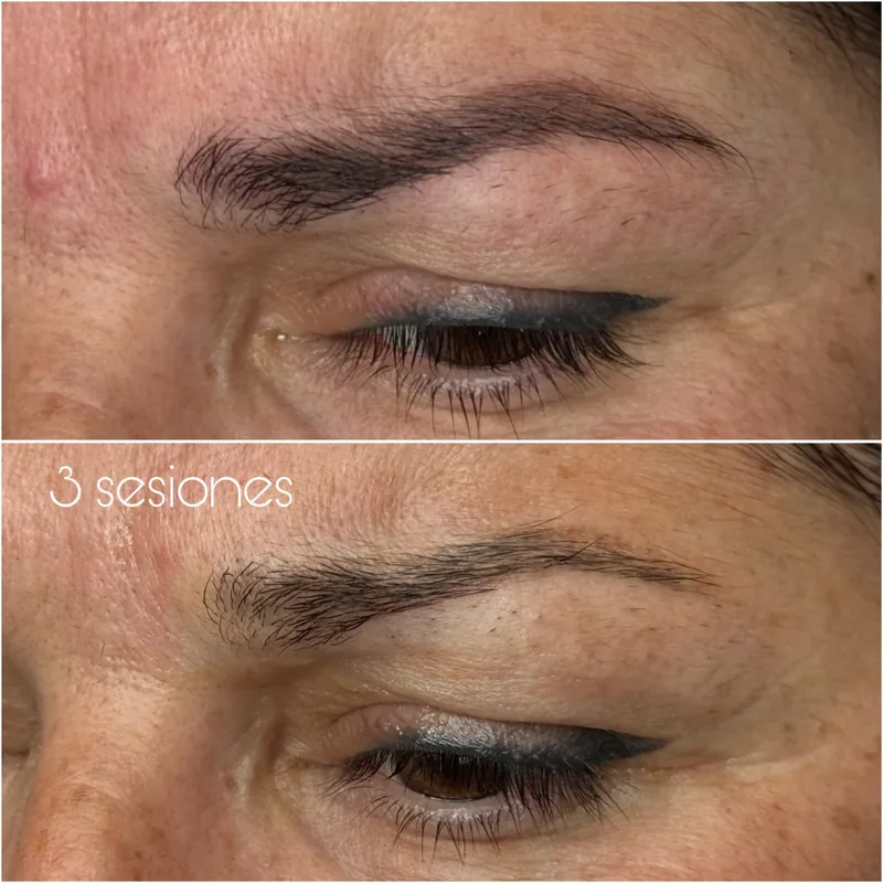 Cejas con pigmento antiguo antes y después de tres sesiones de láser